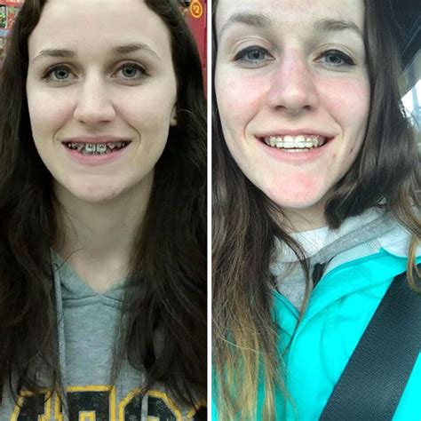1 month braces transformation|114 Incredible Before & After Transformations Of .